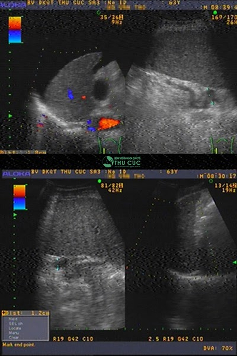 Xơ gan vẫn có thể hồi phục nhờ phác đồ tái tạo tế bào gan - 2 Xơ gan vẫn có thể hồi phục nhờ phác đồ tái tạo tế bào gan - 2