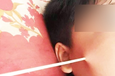 Học sinh bị xiên que đâm thủng mặt ở sân trường