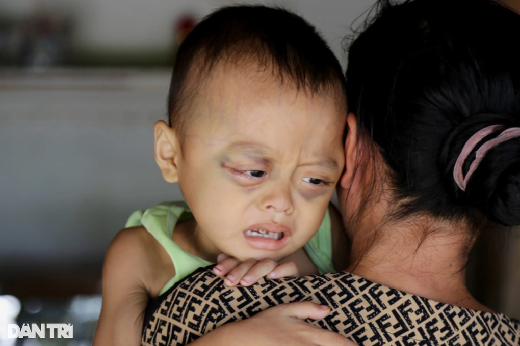 Rơi nước mắt bé 3 tuổi chỉ còn da bọc xương, chống chọi với bệnh ung thư - 4 Rơi nước mắt bé 3 tuổi chỉ còn da bọc xương, chống chọi với bệnh ung thư - 4