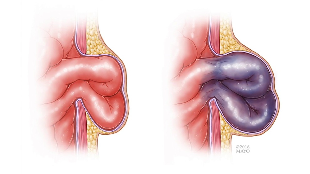 Quý ông suýt mất đoạn ruột vì đau vùng kín nhưng ngại đi khám - 1 Quý ông suýt mất đoạn ruột vì đau vùng kín nhưng ngại đi khám - 1