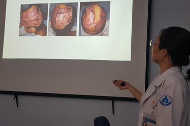 Dùng vạt cơ vùng đùi che phủ hộp sọ cho bé gái bị lột hết da đầu