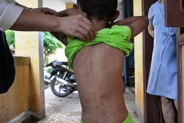 Làm rõ vụ dì ruột bạo hành cháu 5 tuổi