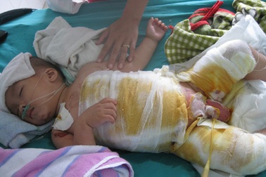 Lời cầu cứu của 3 đứa trẻ bị bỏng nặng 