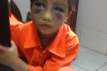 Dự kiến hai mức xử lý giáo viên đánh học sinh tím mặt ở Lào Cai