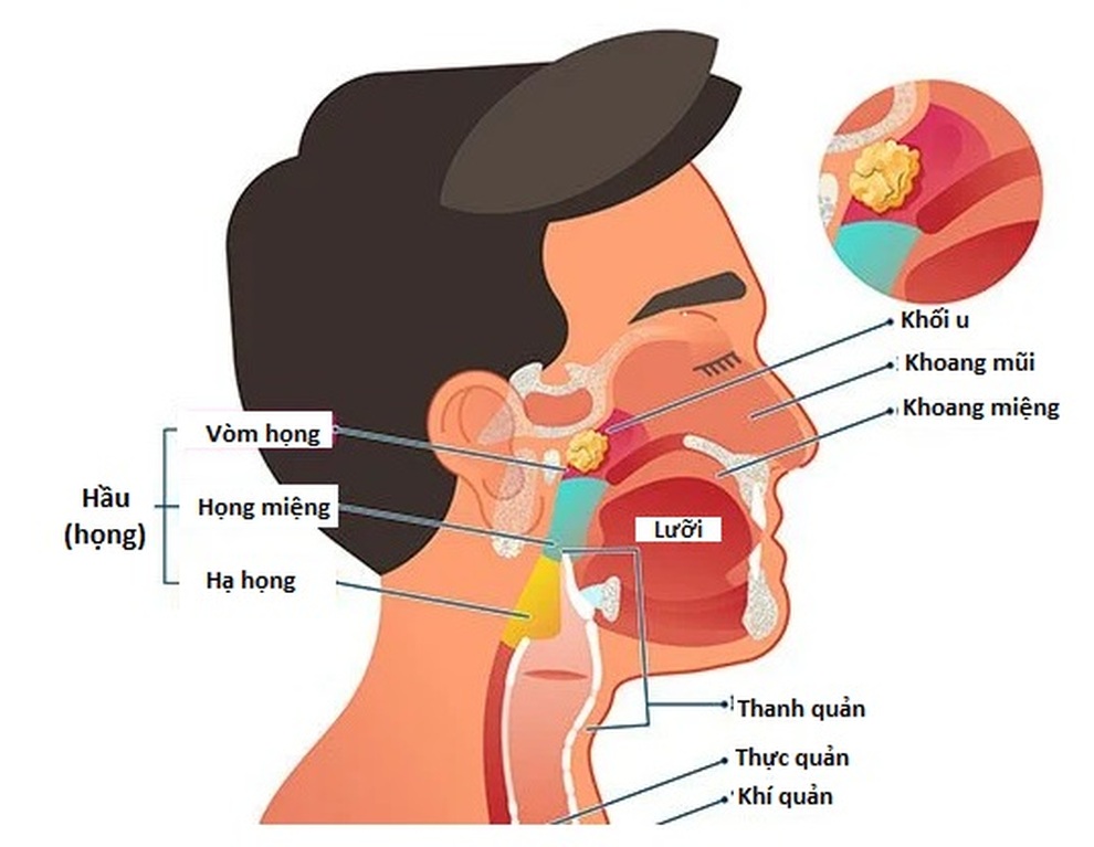 Các phương pháp chẩn đoán ung thư vòm họng - 1 Các phương pháp chẩn đoán ung thư vòm họng - 1