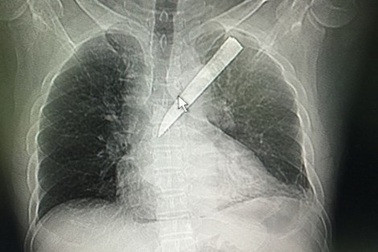 Mang lưỡi dao gãy trong phổi đi cấp cứu