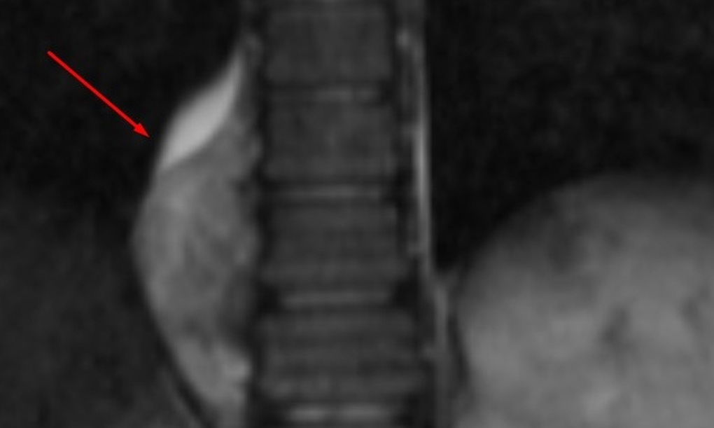 Vào viện điều trị viêm amidan, bé gái 9 phát hiện bị u thần kinh - 1 Vào viện điều trị viêm amidan, bé gái 9 phát hiện bị u thần kinh - 1