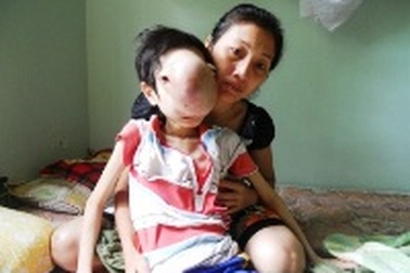 Cậu bé không có khuôn mặt người đang có hy vọng được cứu chữa