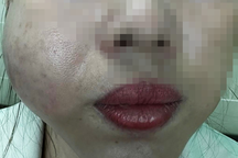 Tiêm filler làm biến dạng mặt người phụ nữ, spa "lột xác" đổi tên mới