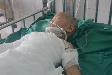 Bố điên, mẹ dại, con gái 4 tuổi nguy kịch vì bỏng lửa