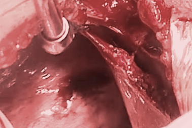 Bệnh viện quận cứu sống bệnh nhân bị đâm thủng tim