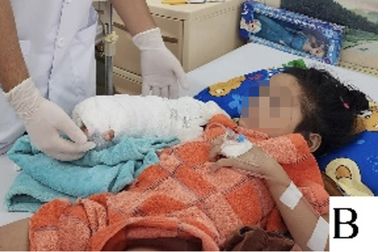 Áo khoác cuốn vào xe máy làm bé 5 tuổi đứt lìa tay, vào 4 bệnh viện cấp cứu