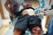 Nam thanh niên nát bàn tay sau tiếng nổ lớn trong đêm giao thừa