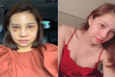 Lưu Đê Ly gây sửng sốt khi công khai quá trình “đập mặt xây lại”