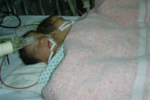 Nhiều bất lợi nếu mổ tách cặp song sinh đặc biệt