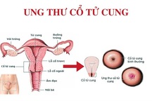 Dấu hiệu ung thư cổ tử cung giai đoạn sớm và khi tiến triển