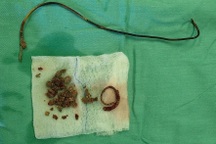 Cụ bà quên ống thông tiểu suốt 8 năm trong niệu quản