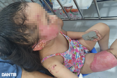 Vụ thai phụ sắp sinh bỏng thương tâm vì nướng mực: Bé 4 tuổi cháy mặt, đùi