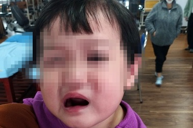 Bé 2 tuổi bị méo miệng vì sự chủ quan của người lớn