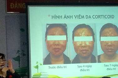 Hiểm hoạ từ công thức chế kem đẹp da có chứa corticoid