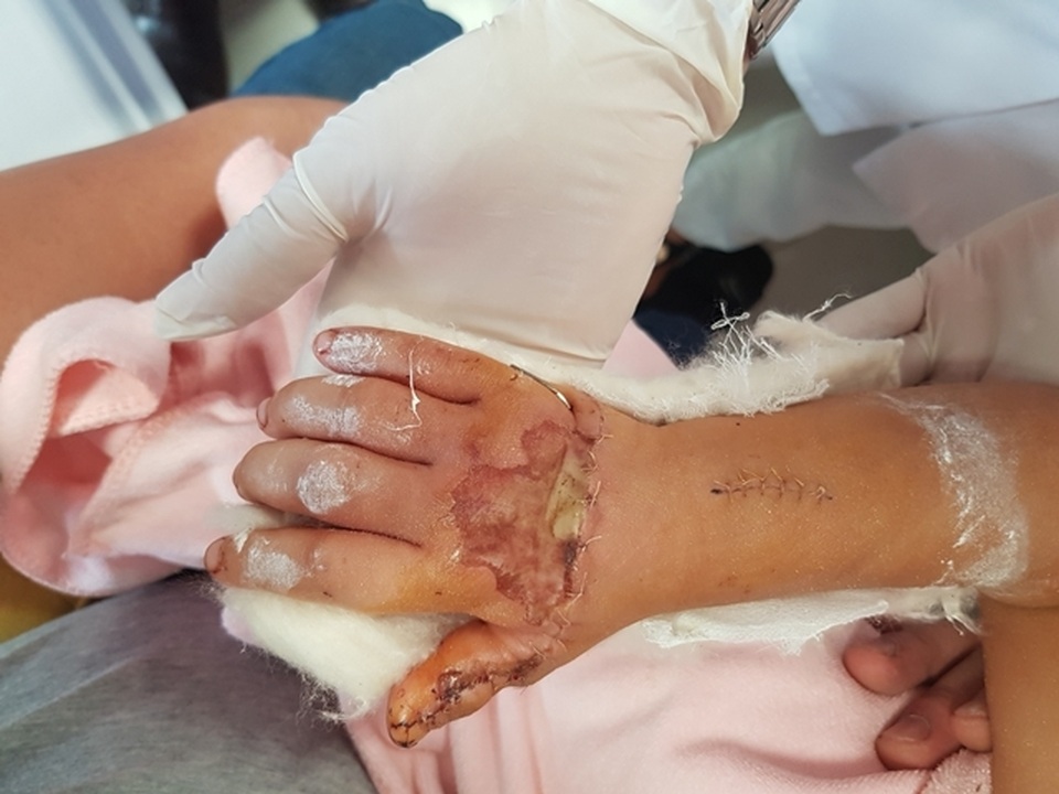 Bé gái 3 tuổi bị máy dập cốc cán gần đứt lìa bàn tay - 1 Bé gái 3 tuổi bị máy dập cốc cán gần đứt lìa bàn tay - 1
