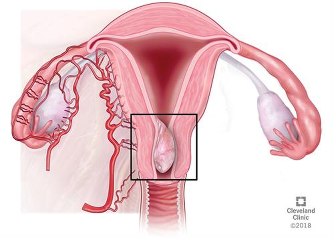 Polyp tử cung: Dấu hiệu cảnh báo và cách điều trị - 1 Polyp tử cung: Dấu hiệu cảnh báo và cách điều trị - 1