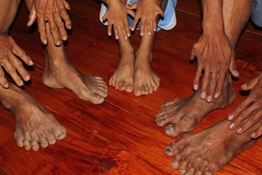 Gia tộc có 14 người chân tay 6 ngón