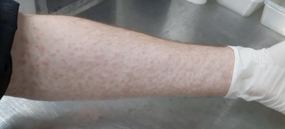 Cho hàng nghìn con muỗi đốt người để nghiên cứu khoa học - 2 Cho hàng nghìn con muỗi đốt người để nghiên cứu khoa học - 2