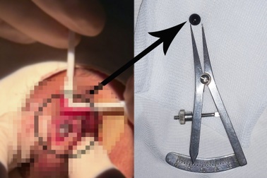 Cấp cứu nam sinh 15 tuổi bị viên bi sắt bắn và găm vào mắt nhiều ngày