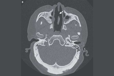 Người phụ nữ bị tiêu mất mũi do bệnh tự miễn hiếm gặp