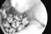 Hàng chục con giòi lúc nhúc trong tai người đàn ông 53 tuổi