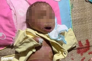 Cháu bé ở Bình Thuận mang da vảy cá toàn thân, cả thế giới chỉ có 200 ca