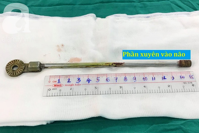 Mẹ hốt hoảng khi thấy con trai 5 tuổi cầm thanh sắt chạy đi chơi thì bị đâm xuyên hốc mắt lên đến não - Ảnh 8. Mẹ hốt hoảng khi thấy con trai 5 tuổi cầm thanh sắt chạy đi chơi thì bị đâm xuyên hốc mắt lên đến não - Ảnh 8.