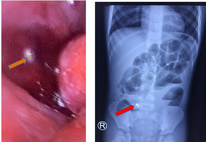 Bé gái 3 tuổi bị thủng ruột vì 2 viên nam châm bé xíu - Ảnh 1.