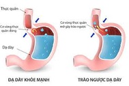 Trào ngược dạ dày thực quản có thể dẫn đến ung thư?