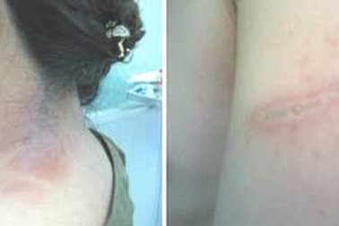 Trị viêm da tiếp xúc do côn trùng