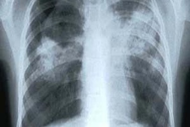 Việt Nam trong top những nước có nhiều bệnh nhân lao mới