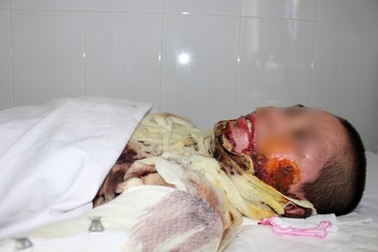 Hút thuốc khi đang đổ xăng, nam thanh niên bị thiêu sống