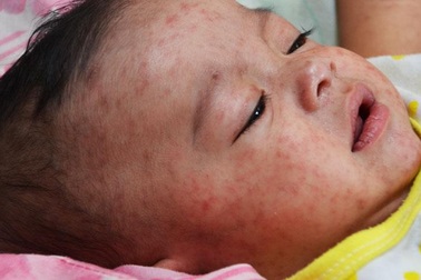 Bệnh sởi đã bị xóa sổ ở Mỹ