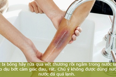 Mẹo chữa bỏng nhẹ nhờ nguyên liệu tự nhiên