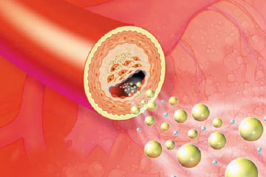 Lipidcleanz - Giải pháp giúp hỗ trợ kiểm soát rối loạn lipid máu