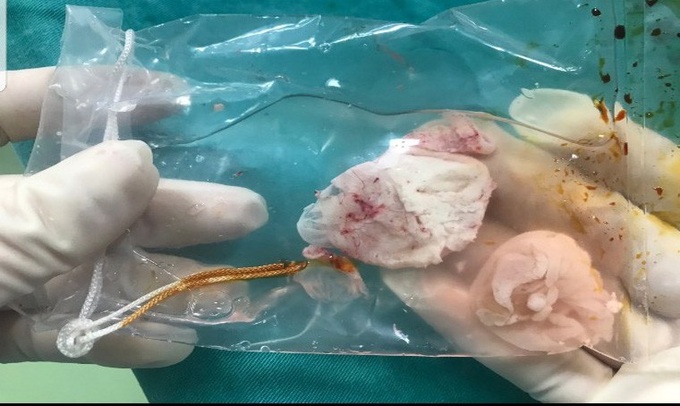 Kinh hoàng một bệnh nhân mắc tổ sán khổng lồ trong não do thói quen ăn những món này - Ảnh 2. Kinh hoàng một bệnh nhân mắc tổ sán khổng lồ trong não do thói quen ăn những món này - Ảnh 2.
