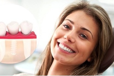 Dịch vụ cấy ghép Implant hoàn hảo