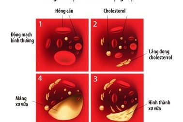 Vì sao người gầy vẫn bị rối loạn mỡ máu, cao huyết áp?