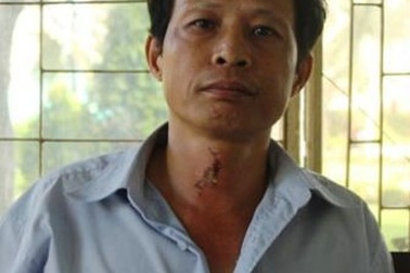 Vụ một gia đình bị tạt axit: Các nạn nhân nguy kịch