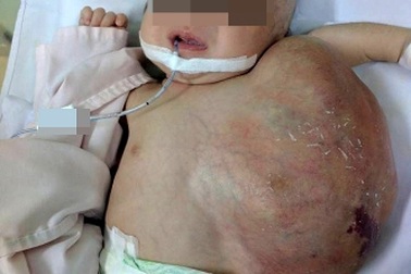 Bé gái chào đời mang theo “bướu quỷ” trên cổ