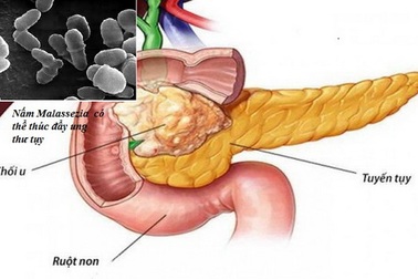 Nấm đường ruột có thể thúc đẩy ung thư ở tuyến tụy