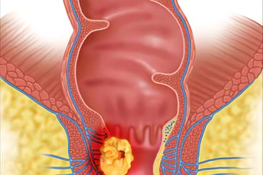 Phòng ngừa ung thư hậu môn