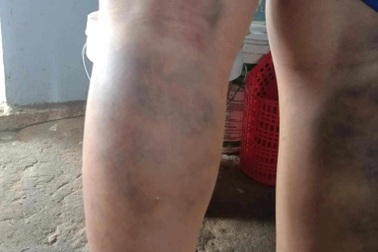 Đình chỉ giáo viên chủ nhiệm đánh học sinh bầm tím 2 chân