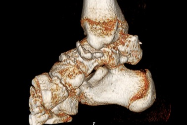 Mổ lấy gần 20 hạt sụn trong khớp cổ chân cậu thiếu thiên 15 tuổi